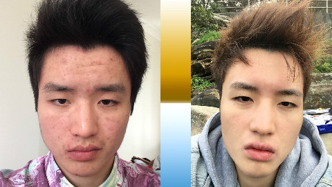 【祛痘护肤】给曾经的痘友和那些被痘痘折磨的人〔绝无任何广告内附基本步骤和基本产品〕