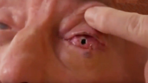 用牙齿做眼球,居然重见光明了,100%真实医疗奇迹