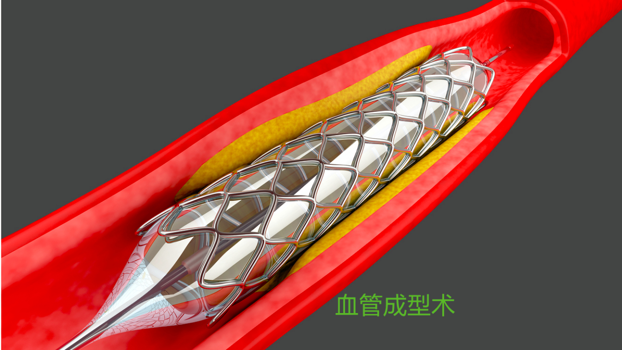 血管堵塞,医生是用这个方法恢复通畅的,3D动画展示整个过程