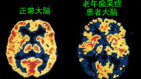 老年痴呆症能预防吗?不用怕!即使患老年痴呆症你仍能理解爱与喜悦