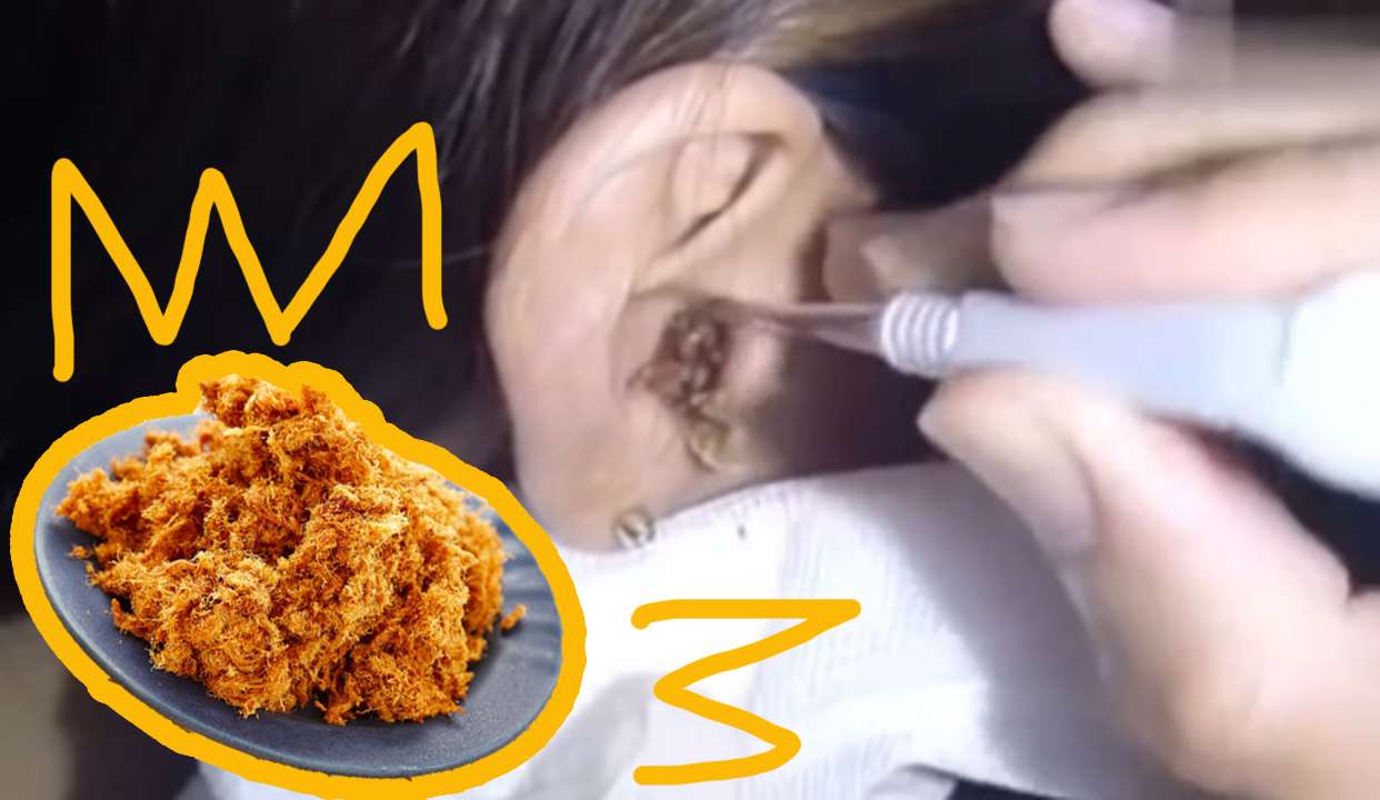 为啥耳屎高产似母猪?你耳屎像肉松还是蜡?
