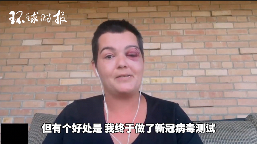 美国记者被警察击中眼睛:在美国想做新冠病毒检测、仅仅需要一个眼球