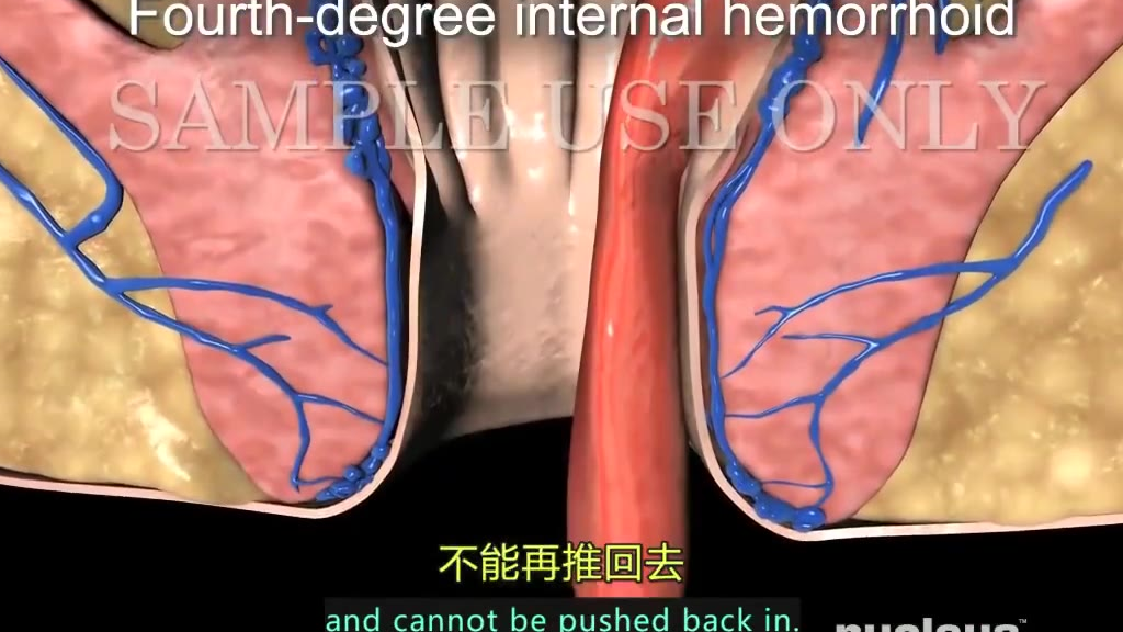 3D医学动画,你的痔疮是如何形成,看的我菊花一紧