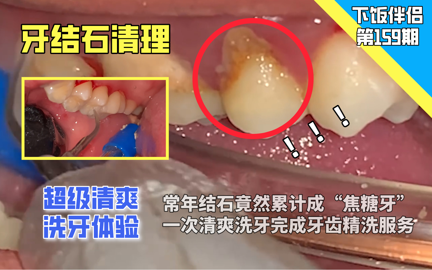 【下饭伴侣】常年牙结石累计成“焦糖牙”一次清爽洗牙完成牙齿精洗服务... ...