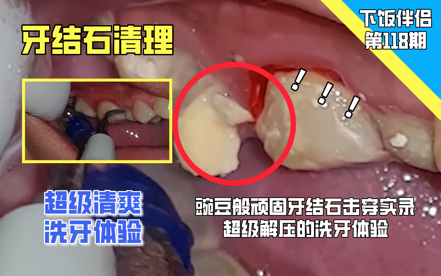 【下饭伴侣】豌豆般顽固牙结石击穿实录,超级解压的洗牙体验... ...